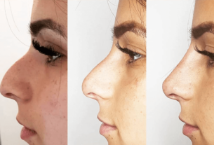 Non-surgical nose job