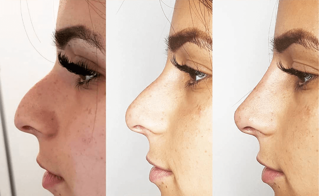 Non-surgical nose job